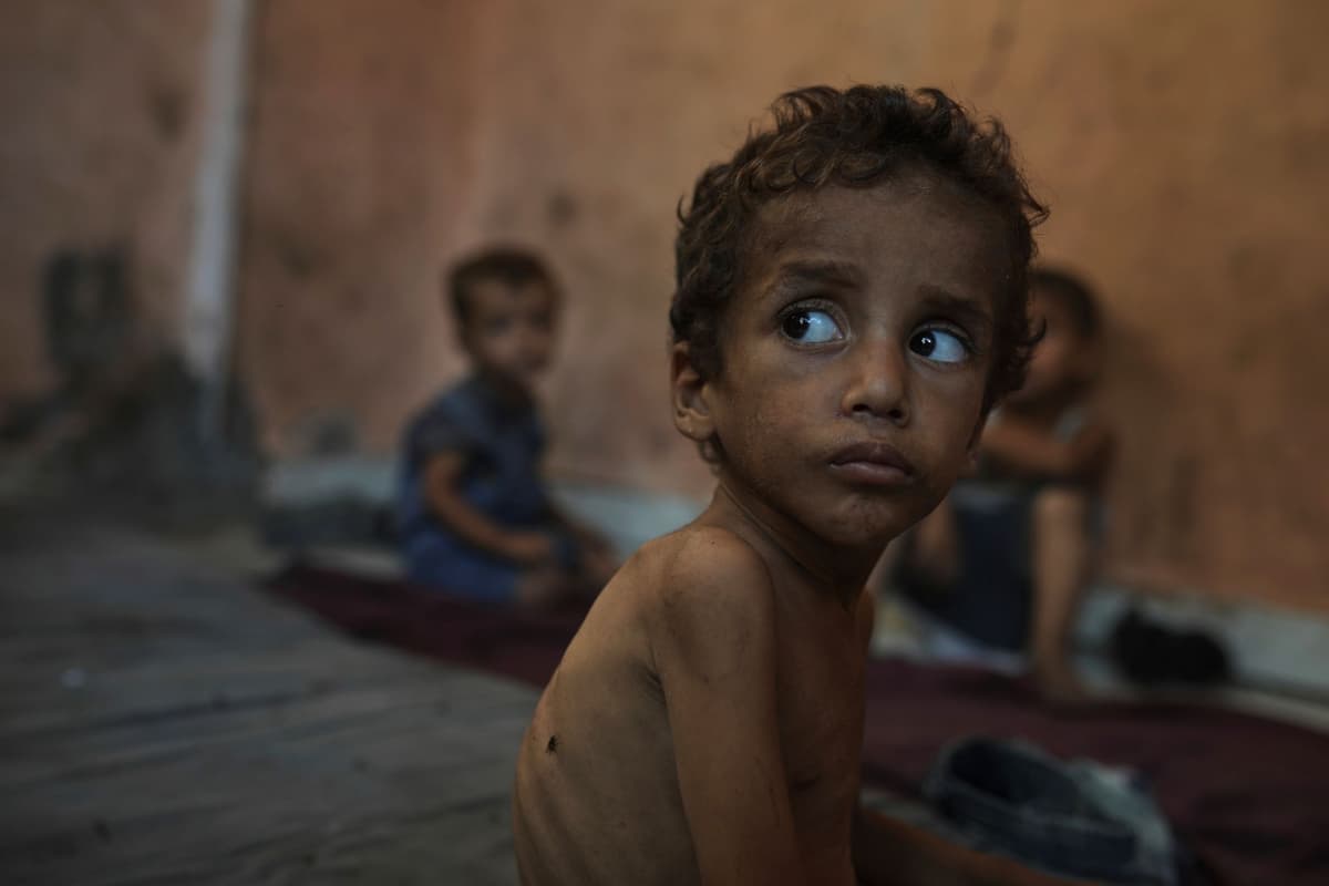 Yazan Abu Ful, dvojročné podvyživené dieťa, sedí v stredu 23. júla 2025 vo svojom rodinnom dome v utečeneckom tábore Shati v meste Gaza. Foto: TASR/AP